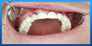 teeth hurt after rhinoplasty