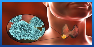 Thyroid cancer treatment