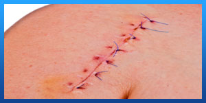 Shoulder Replacement Surgery Scar