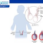 Testicular Torsion