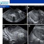 Retained Products of Conception (RPOC)