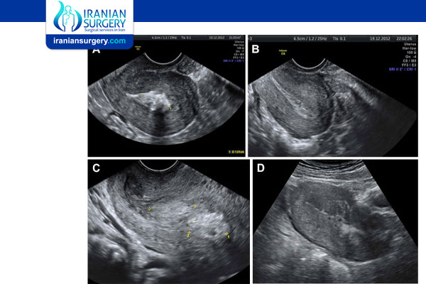 Retained Products of Conception (RPOC)