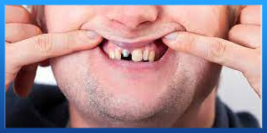 Dental implant Risks