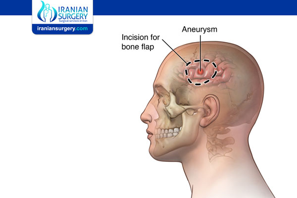 Craniotomy Recovery