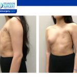 Poland Syndrome Breast