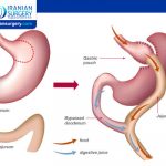 Bariatric Surgery Side Effects