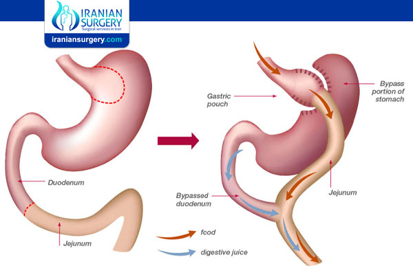Bariatric Surgery Side Effects
