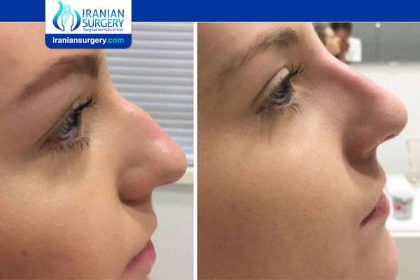 Does Non-Surgical Rhinoplasty Last Forever?