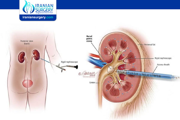 kidney stone surgery complications