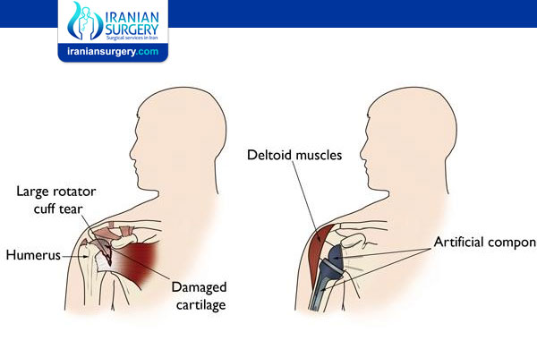 what muscles are cut during a total shoulder replacement