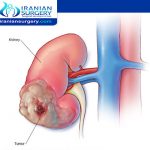 kidney cancer survival rates by age