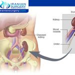 kidney transplant