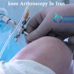 knee arthroscopy Iran cost