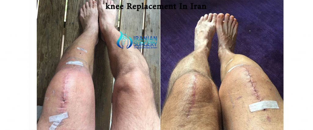 knee replacement cost iran