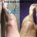 knee replacement cost iran