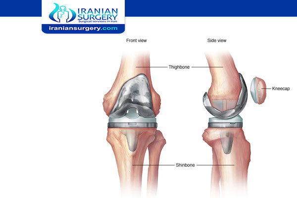 how long do you have pain after knee replacement surgery?