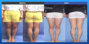 leg lengthening surgery before and after photos 