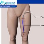 leg pain after varicose vein surgery