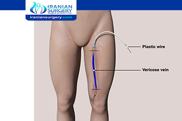 leg pain after varicose vein surgery