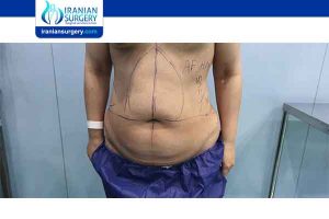 5 Way to Get rid of Lumps After Liposuction - Raadina Health