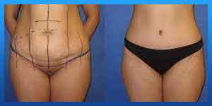 lipo laser