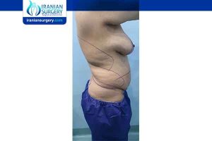 liposuction in iran with breast augmentation