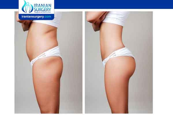 Liposuction New York