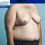 male breast reduction 2