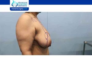minimum size for breast reduction