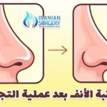 نزول ارنبة الأنف بعد عملية التجميل