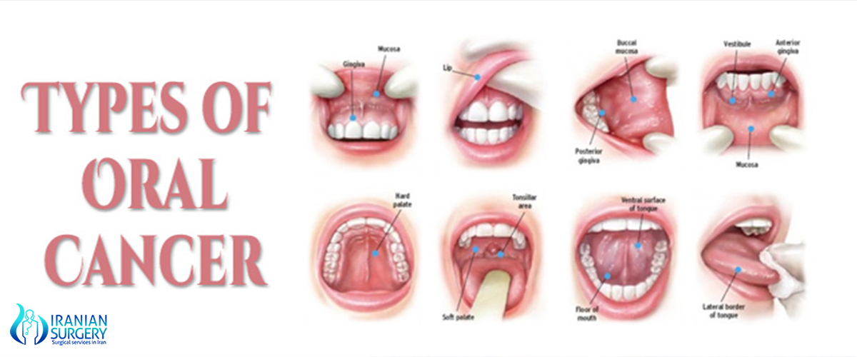 Oral Cancer Treatment In Iran Oral Cancer Type Iranian