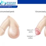 partial circumcision