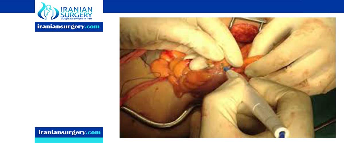 partial colectomy surgery