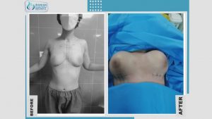 جراحة تصغير الثدي مع ايرانيان سرجري