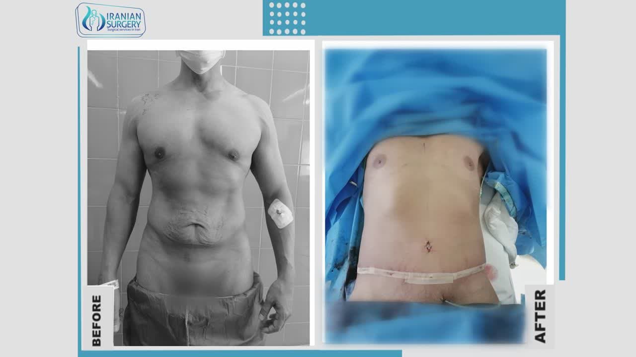 Tummy Tuck in Iran, Abdominoplasty + Cost + Surgeon