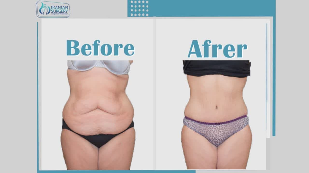 What is the difference between liposuction and lipomatic?