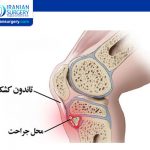 مرض أوزغود شلاتر او بروز الركبة