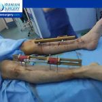 Limb Lengthening Surgery-External Fixators