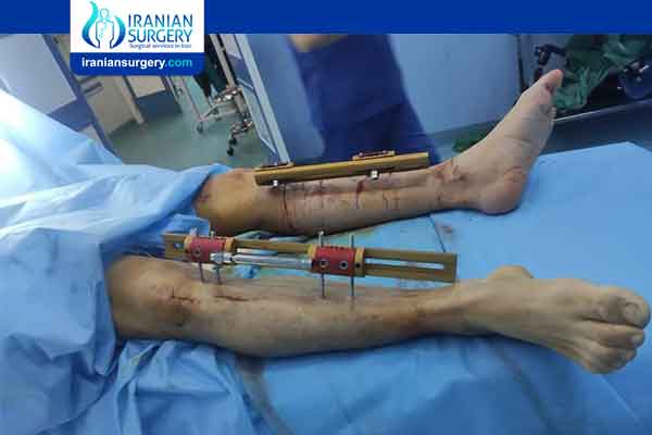 Leg lengthening surgery cost 2023 height surgery cost limb