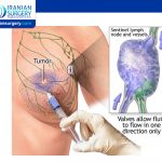 Sentinel Node Biopsy