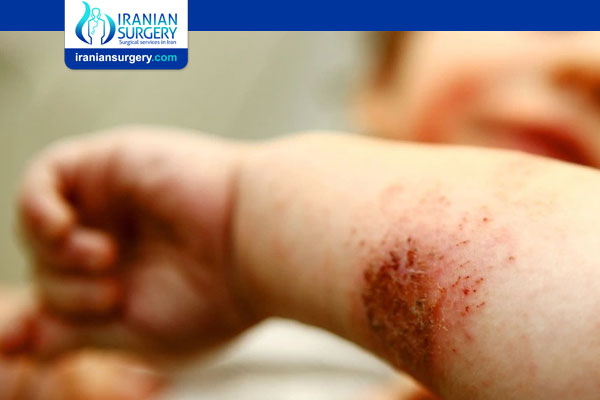 سرطان الجلد عند الأطفال