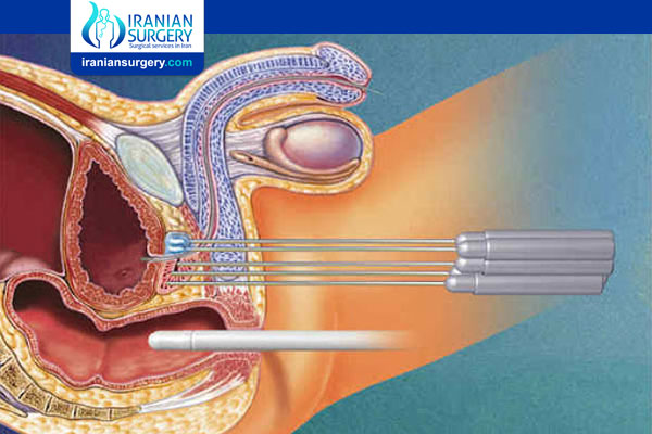 Cryotherapy for Prostate Cancer