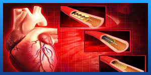 هل عملية قسطرة القلب خطيرة؟