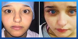 Eye color change surgery