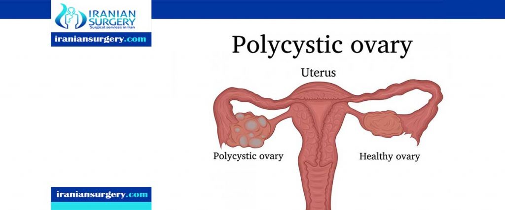 polycystic ovaries causes