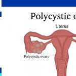 polycystic ovaries causes