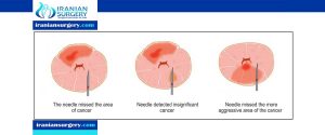 prostate biopsy anesthesia