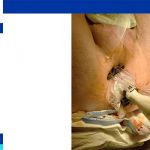 prostate biopsy complications