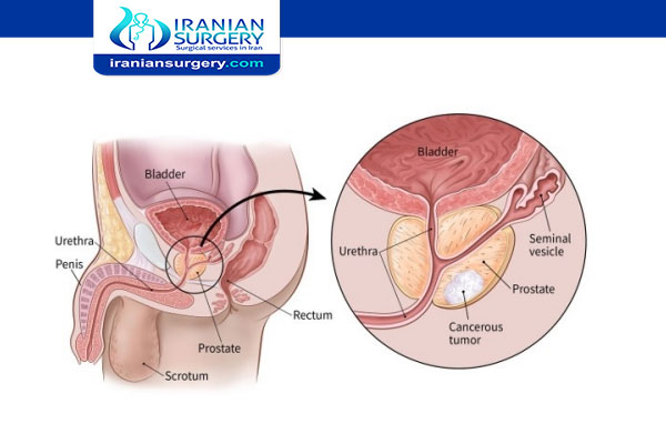 prostate cancer treatments pros and cons