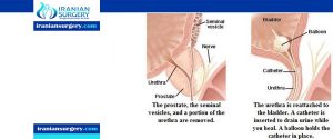 prostatectomy complications